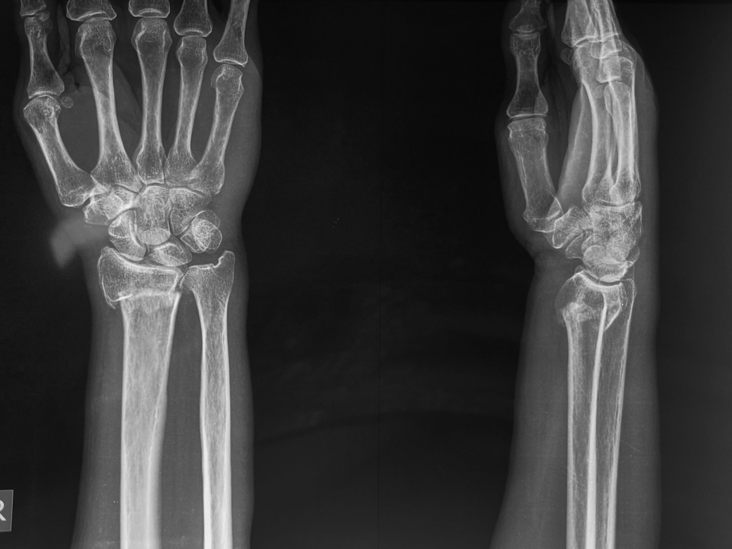 Distal radius fracture, before
