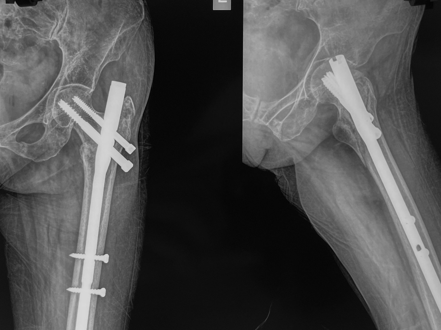 Intertrochanteric hip fracture, after