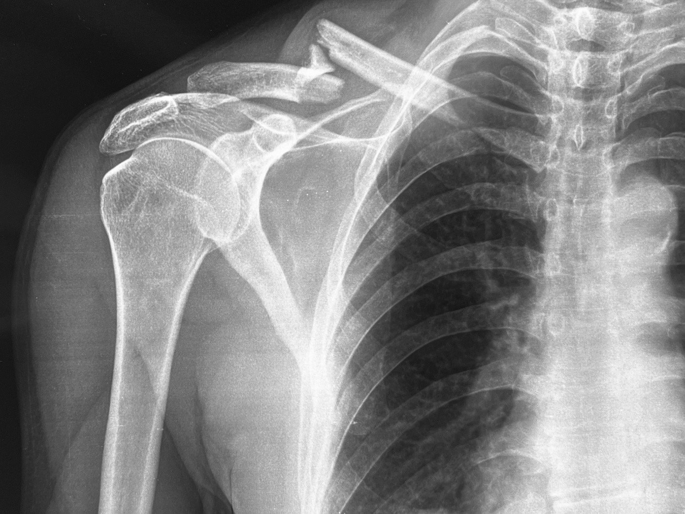 Clavicle fracture, before