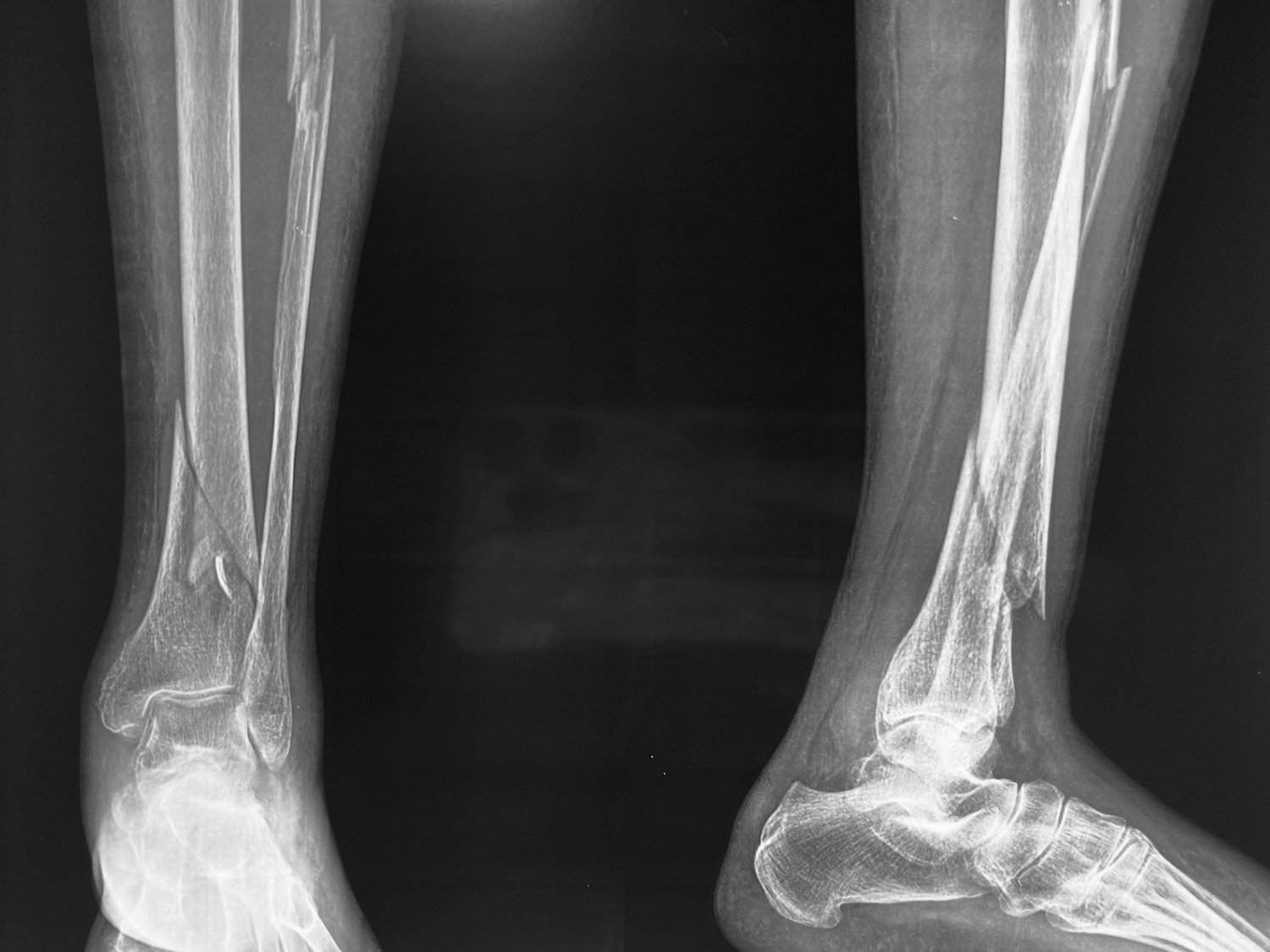 Distal tibia fracture, before