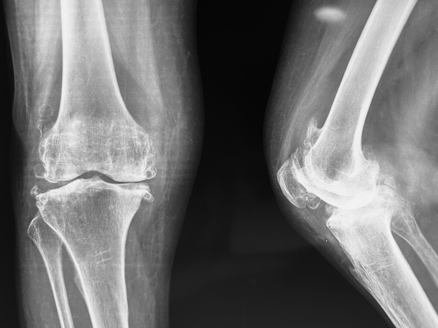 Total knee replacement, before