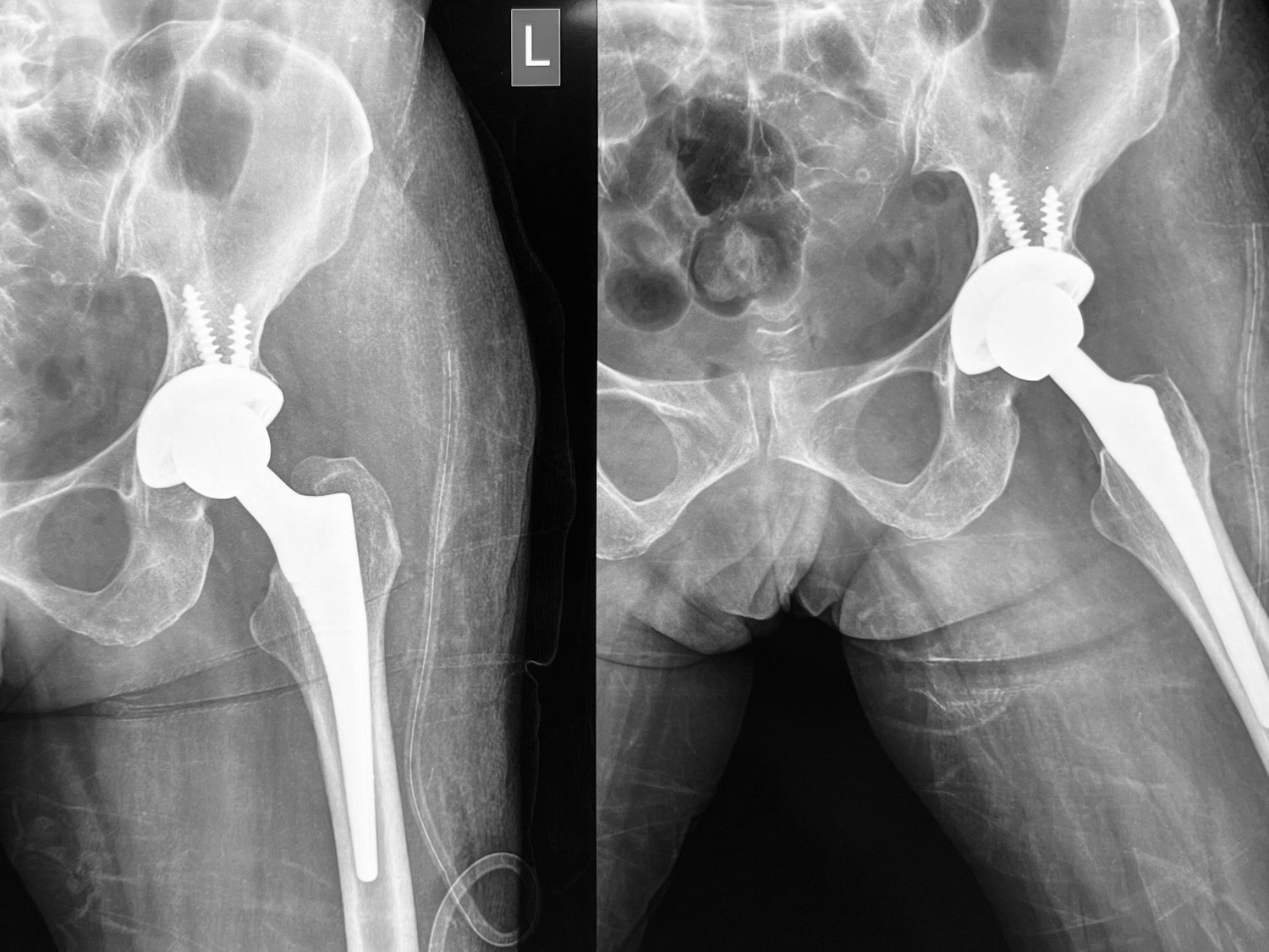 Total hip replacement, after